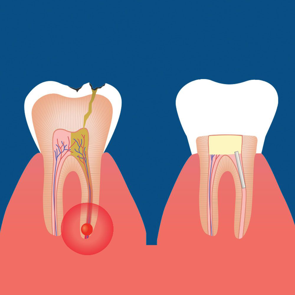 If needing a root canal, Sonora dentist Jeff Berger, DDS, can handle it with ease.