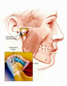 TMJ symptoms that require TMJ treatment can include pain when moving the jaw in routine ways.