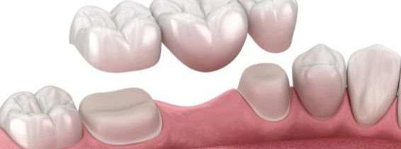 Dental Bridges vs Implants