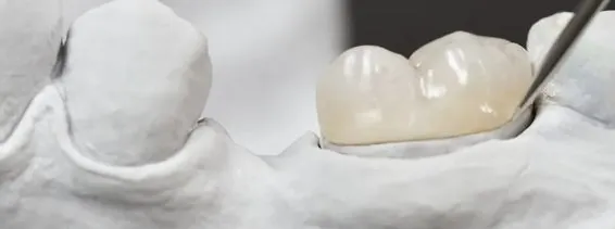 How Long Do Dental Crowns Last?