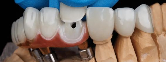 What Is Cosmetic Dentistry and What Procedures Are Available