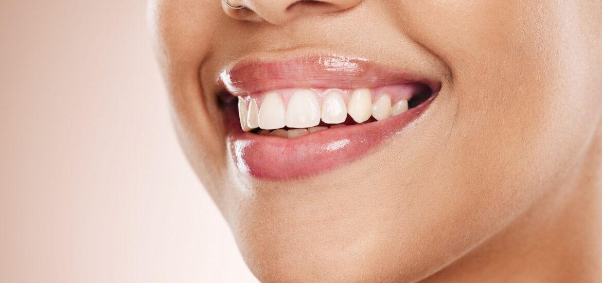 How Long Does Teeth Whitening Last