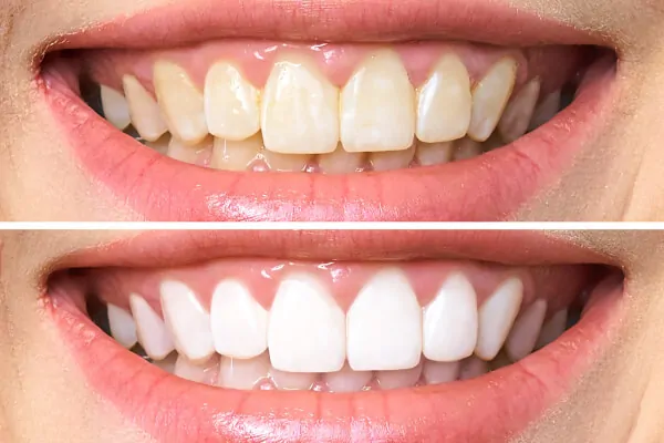 How Much Does a Smile Makeover Cost