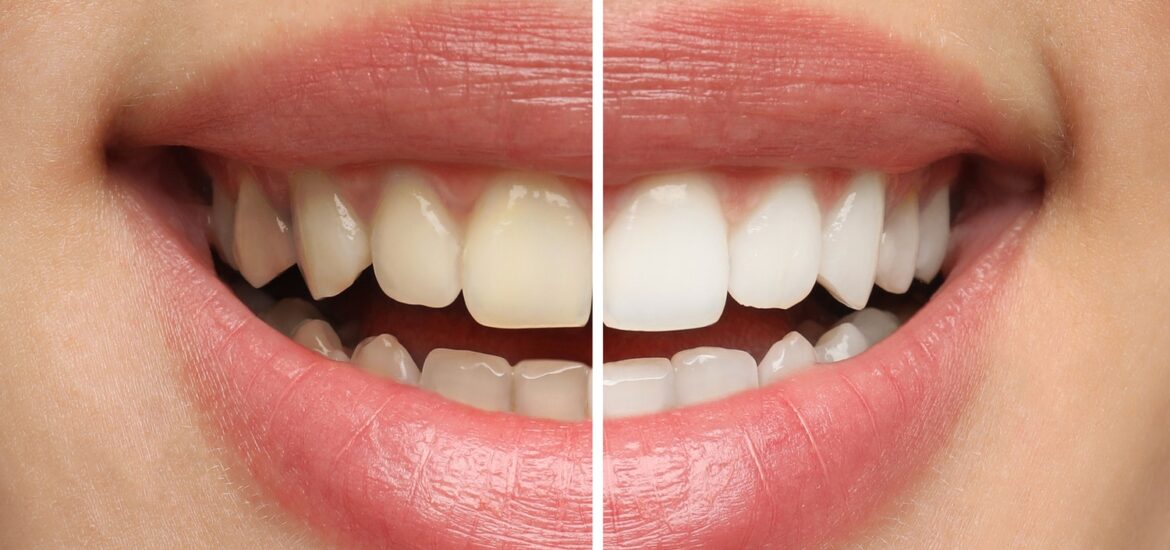 Professional Teeth Whitening vs At-Home Whitening
