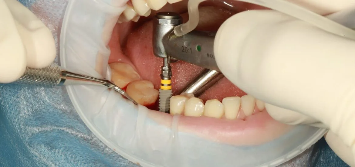 What Are Dental Implants and How Do They Work